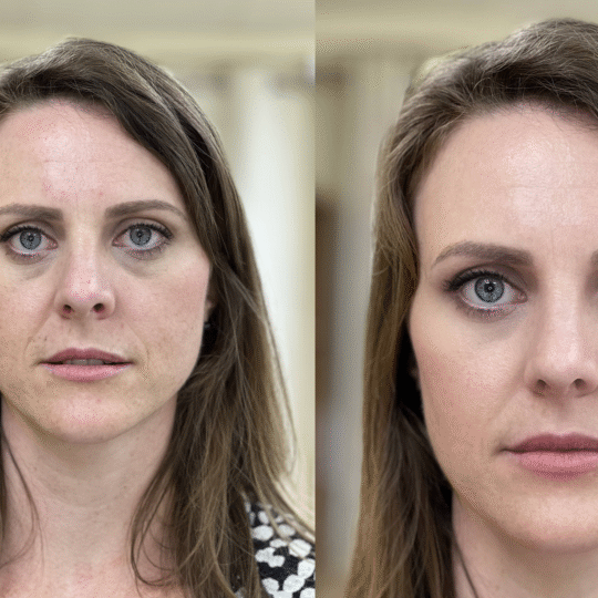 RF Microneedling – Collagen Boosting, Skin Tightening Magic