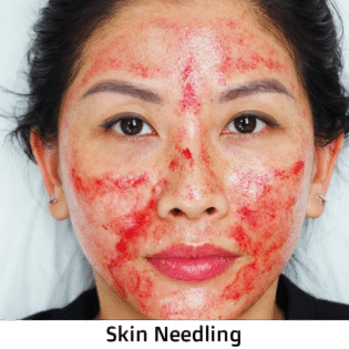 Microneedling with Serum, Exosomes, and Polynucleotides