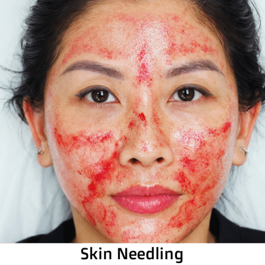 Microneedling with Serum, Exosomes, and Polynucleotides
