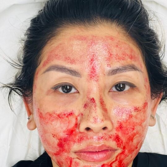 Microneedling Training Course (4 Hours) – CPD Accredited